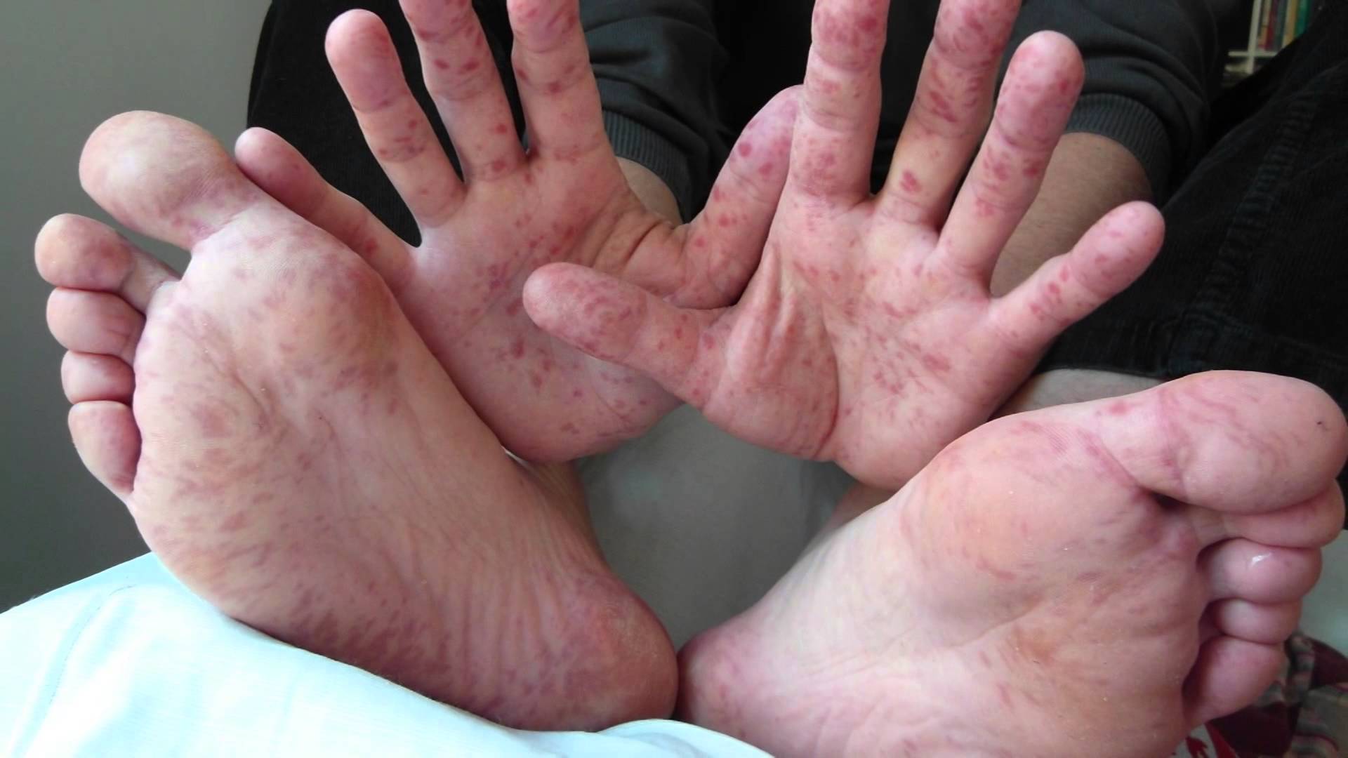 Sëmundja duar-këmbë-gojë është përhapur në Shqipëri, kështu mund të mbroheni